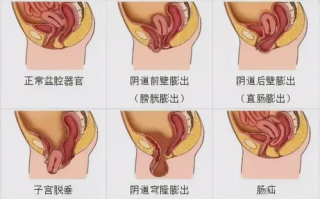 关键部位锻炼与性功能提升-全身综合锻炼方案解析
