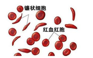 溶血性贫血能根治吗-成因与治疗解析