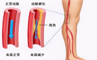 下肢腿部抬高垫与s腿垫翻身垫的使用与效果分析