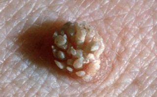 女生经常自己安慰与HPV感染关系解析-健康生活指南