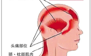 头疼原因分析与应对策略-常见头疼类型及其解决方案
