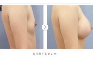水滴形与圆形丰胸对比-手术方法及效果分析