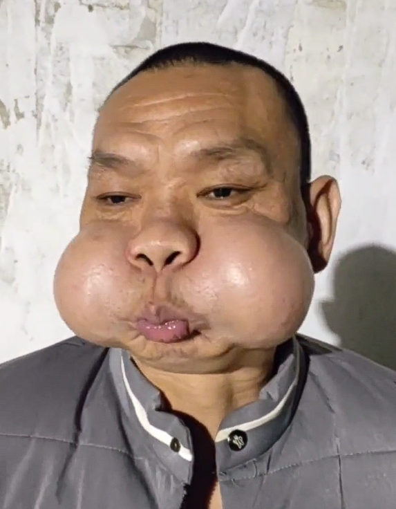 男子工厂吹玻璃30年肌肉拉伤严重：腮帮肿大成“青蛙王子”-第3张图片-佛山资讯网