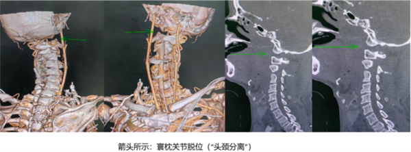 老人意外头颈分离命悬一线 医生出奇招救回-第1张图片-佛山资讯网 老人意外头颈分离命悬一线 医生出奇招救回-第1张图片-佛山资讯网