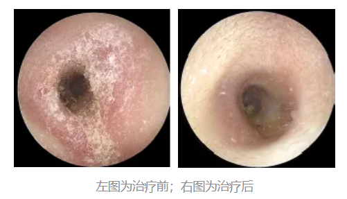 耳朵总是痒却啥也掏不出来:可能暗示这5种问题-第2张图片-佛山资讯网 耳朵总是痒却啥也掏不出来:可能暗示这5种问题-第2张图片-佛山资讯网
