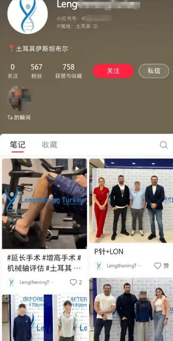 “断骨增高术”隐蔽宣传在国内死灰复燃：专家揭秘手术过程 风险巨大-第1张图片-佛山资讯网