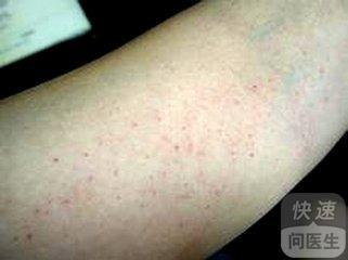 血小板减少性紫癜的根治可能性与治疗策略分析-第1张图片-佛山资讯网 血小板减少性紫癜的根治可能性与治疗策略分析-第1张图片-佛山资讯网
