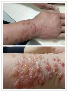 脚上起小水泡还很痒,原因与对策解析-第3张图片-佛山资讯网