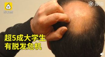 植发多少钱一根，价格因素全解析-植发成本揭秘-第2张图片-佛山资讯网