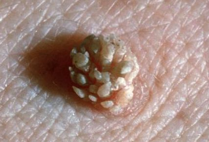女生经常自己安慰与HPV感染关系解析-健康生活指南-第1张图片-佛山资讯网