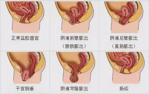 关键部位锻炼与性功能提升-全身综合锻炼方案解析-第1张图片-佛山资讯网 关键部位锻炼与性功能提升-全身综合锻炼方案解析-第1张图片-佛山资讯网