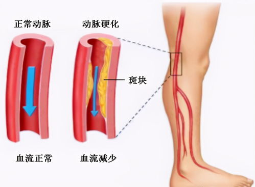 下肢腿部抬高垫、s腿垫、翻身垫使用指南-提高生活质量新选择-第1张图片-佛山资讯网 下肢腿部抬高垫、s腿垫、翻身垫使用指南-提高生活质量新选择-第1张图片-佛山资讯网