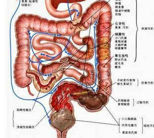 克罗恩病与溃疡性结肠炎的区别-症状、治疗与预防解析-第2张图片-佛山资讯网